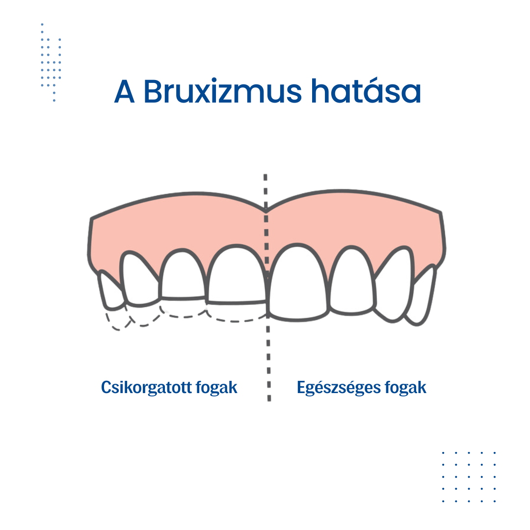 Gnatológia csikorgatott fogak ábrázolása