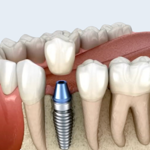 Fogpótlás implantátum használatával